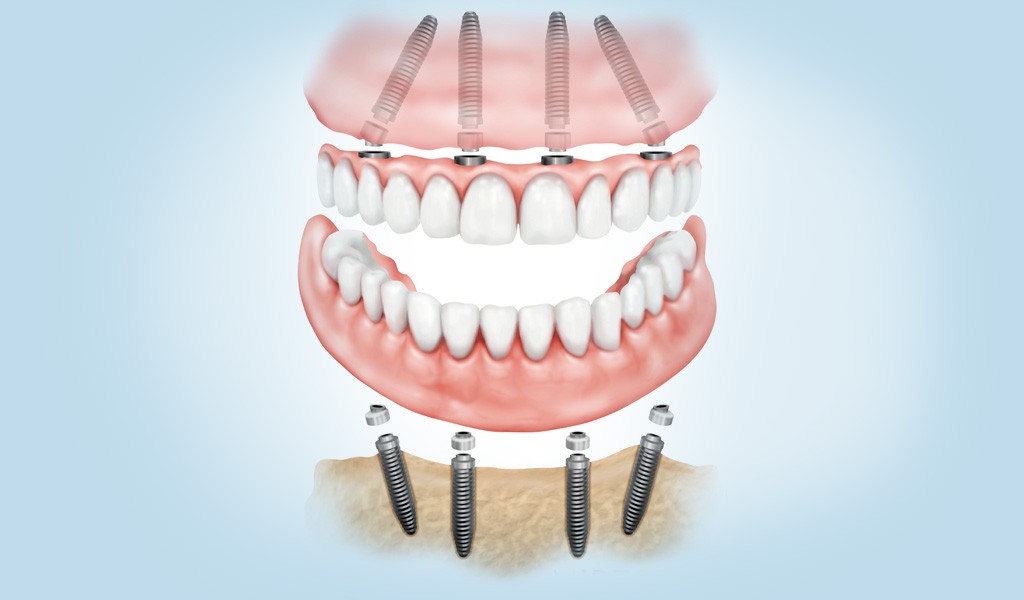 implantes dentales 1 día