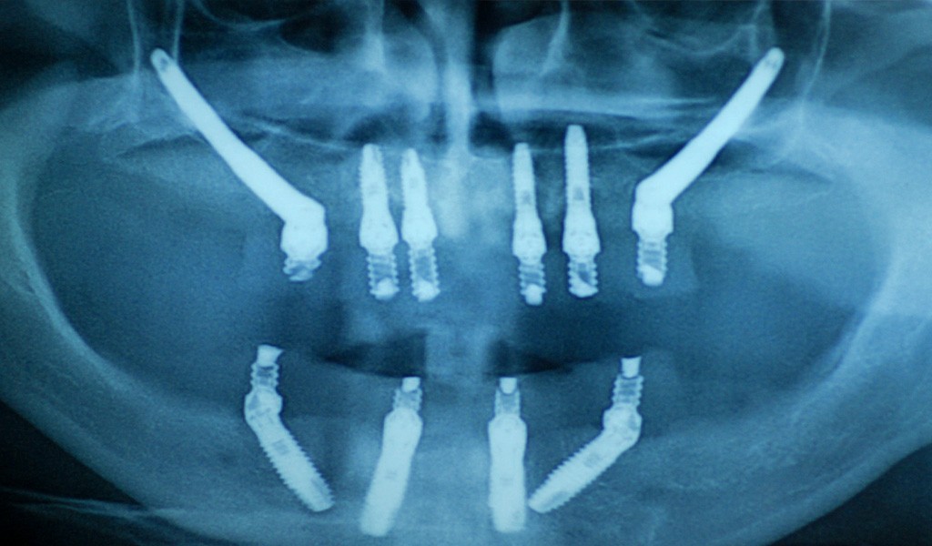 implantes dentales zigomáticos
