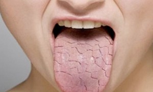 Síndrome de la boca seca