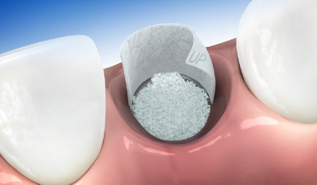  implantes dentales injerto óseo