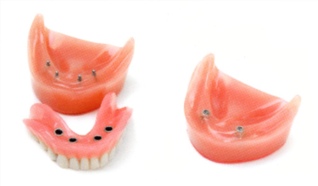 implantes dentales mini-implantes