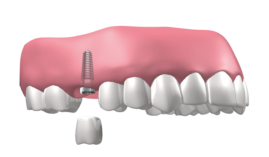 Última tecnología para implantes dentales en Mollet