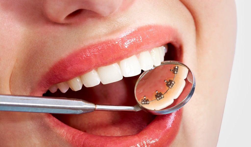 ortodoncia en Mollet