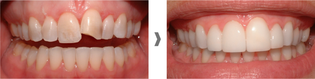 carillas dentales sin rebajar el diente en Sant Cugat