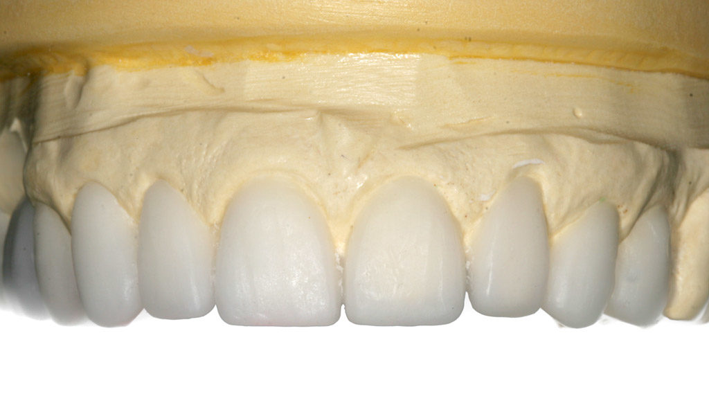 carillas dentales sin rebajar el diente en Mollet