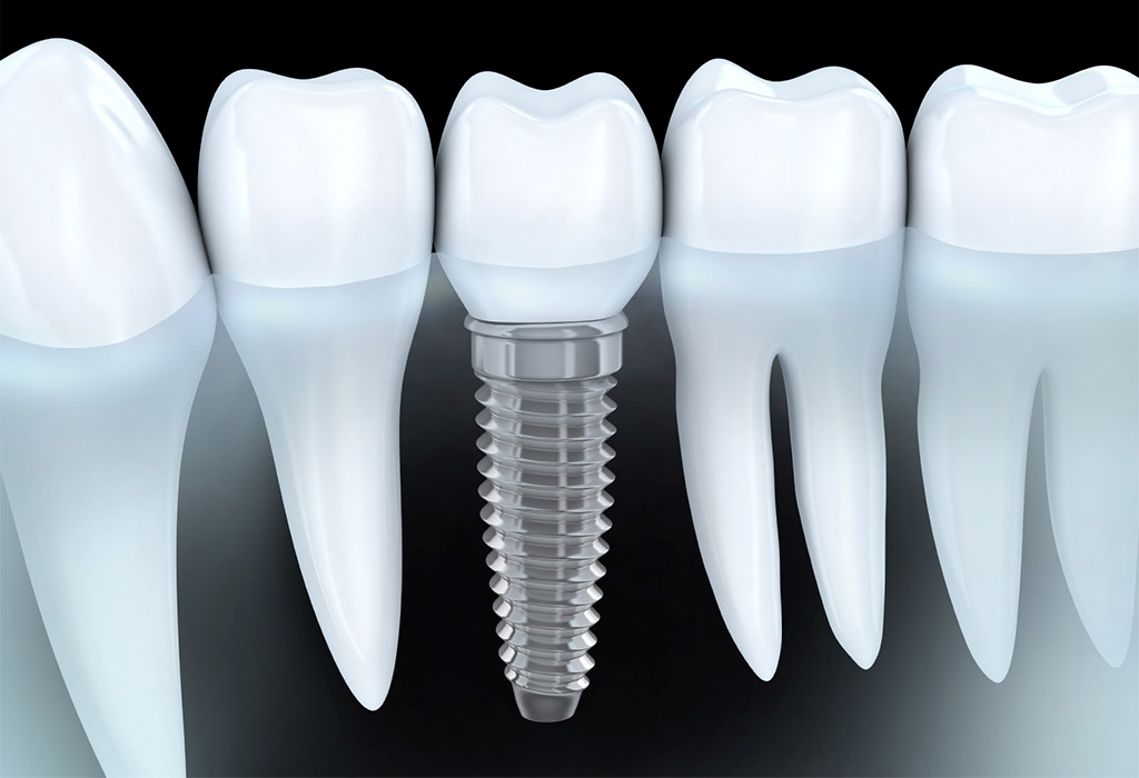 Implantología dental en Sant Cugat