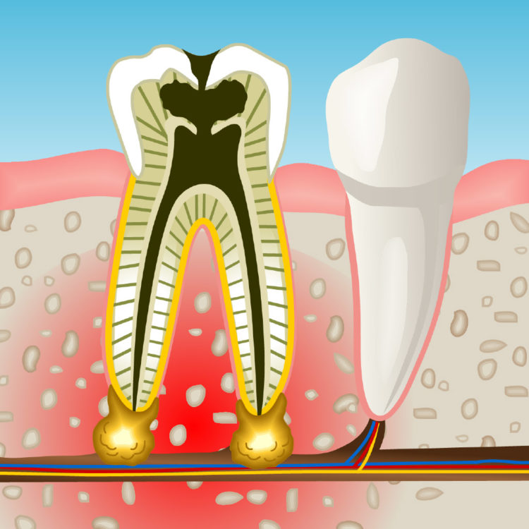 Especialistas en endodoncia en Mollet