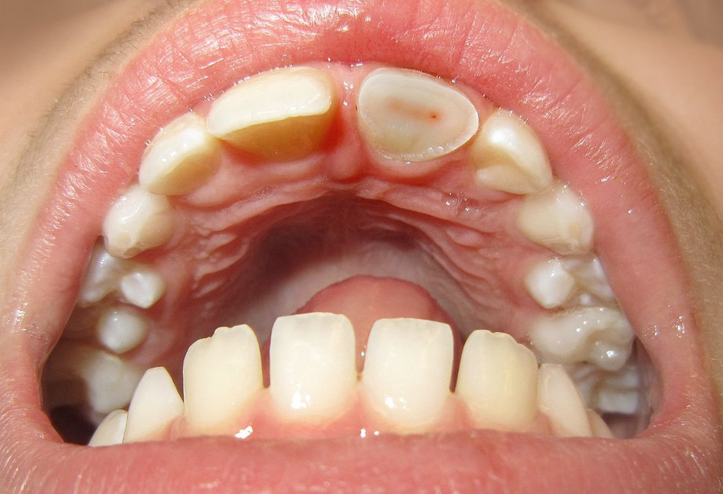 endodoncia en Mollet