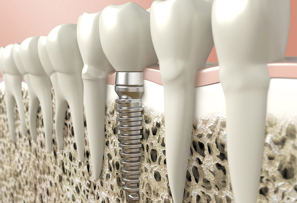 Implantología dental en Mollet