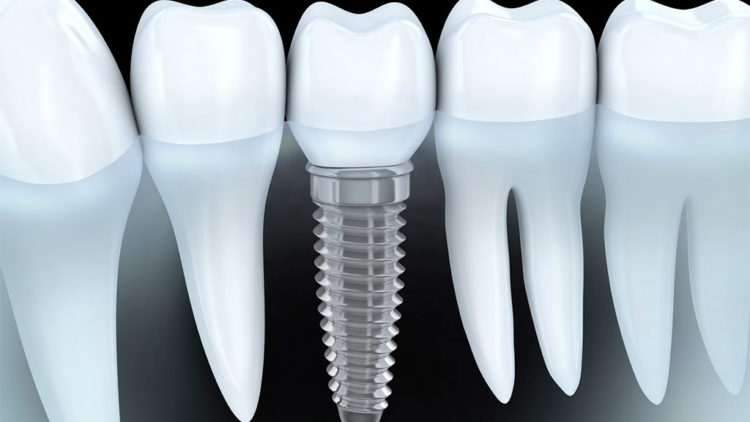 Implantología dental en Mollet