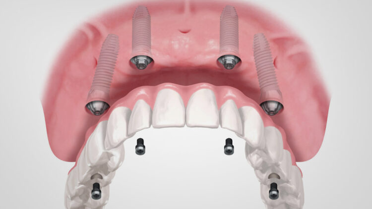 Implantes dentales de carga inmediata en Mollet del Vallès