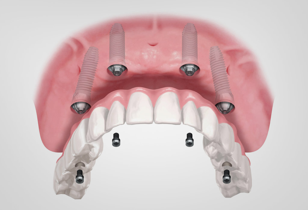 implantes dentales en Sant Cugat y Mollet